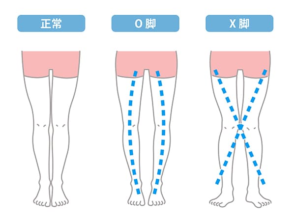O脚とX脚